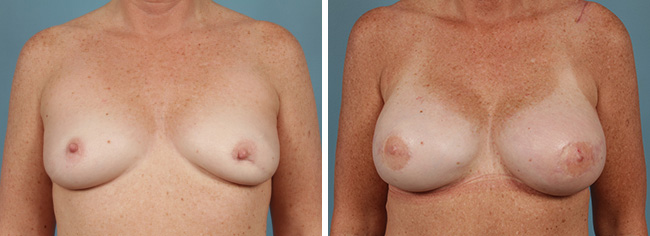 Radiation Therapy & Breast Reconstruction Chicago