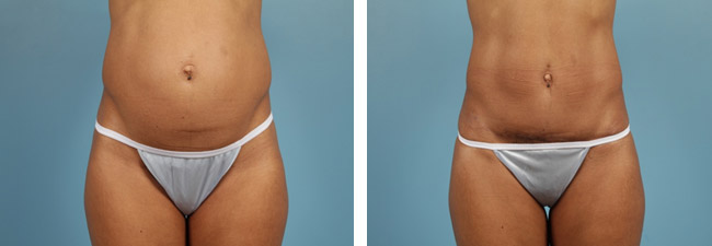 Liposuction Chicago – Fat Reduction Surgery Chicago