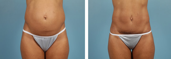 Liposuction In Austin