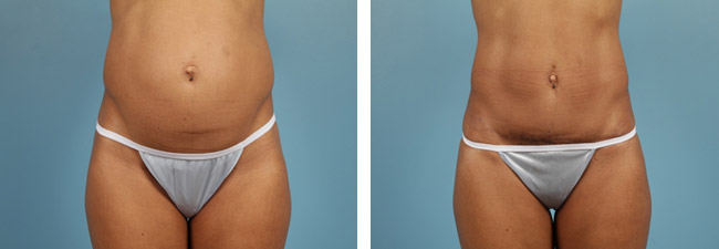 The Procedure For An Outpatient Liposuction Procedure Is