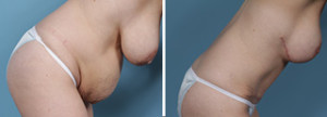 Abdominoplasty