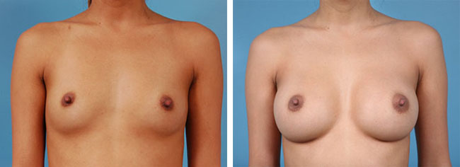 Breast Augmentation300cc Saline Implants
