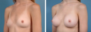 Breast augmentation