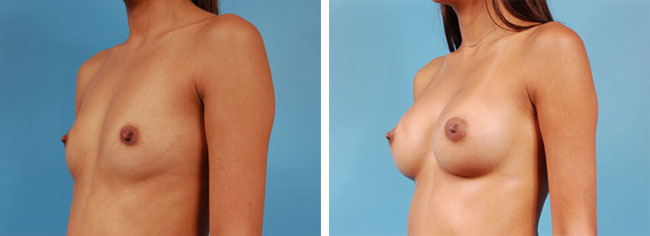 Breast Augmentation300cc Saline Implants