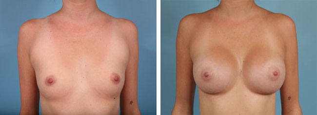 Breast Augmentation350cc Moderate Plus Silicone Gel Implants