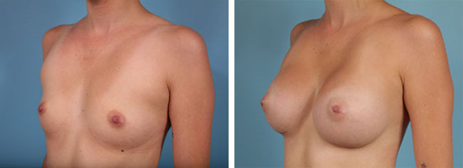 Breast Augmentation350cc Moderate Plus Silicone Gel Implants
