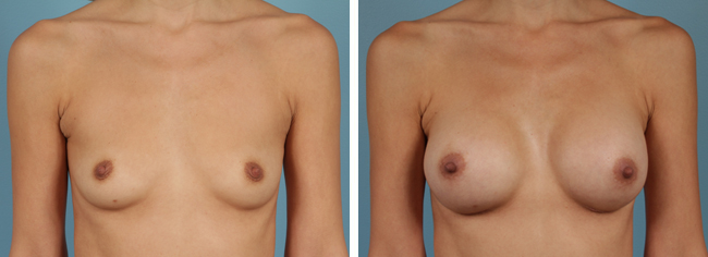 Breast Augmentation286cc Moderate Plus Silicone Gel Implants