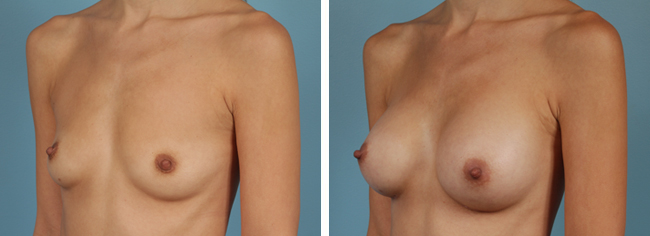 Breast Augmentation286cc Moderate Plus Silicone Gel Implants