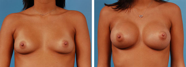 Breast Augmentation275cc Moderate Plus Silicone Gel Implants