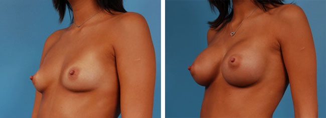 Breast Augmentation275cc Moderate Plus Silicone Gel Implants
