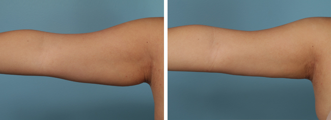 Achieve Toned and Youthful Arms with Arm Lift Surgery (Brachioplasty)