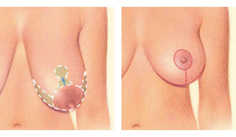 Breast lift: wise incision