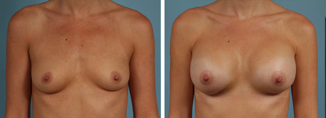 Breast AugmentationBreast Augmentation with 350 cc moderate plus profile implants