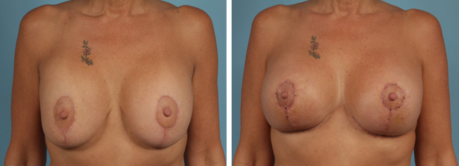 Breast Augmentation Mastopexy Corrective