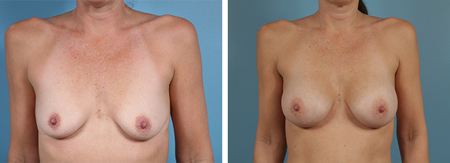 Breast Augmentation375cc Moderate Plus Silicone Gel Implants