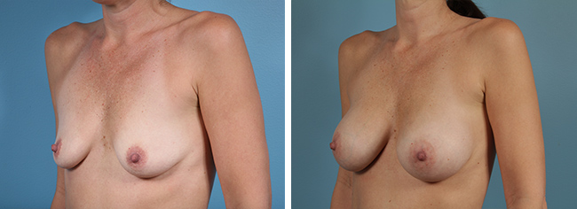 Breast Augmentation350cc Moderate Plus Silicone Gel Implants