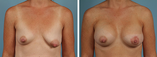 Breast Augmentation Patient with asymmetric breasts