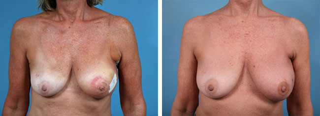 Radiation Therapy & Reconstruction Chicago