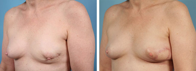 Latissimus Dorsi Flap Reconstruction Chicago