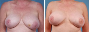 TRAM Flap Breast Reconstruction Chicago
