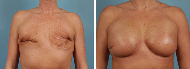 Latissimus Flap Reconstruction Chicago