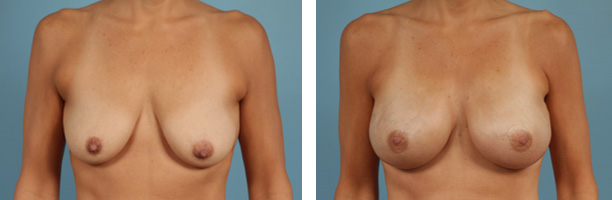 Tissue Expander Breast Reconstruction Before and After Chicago