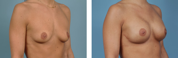 Chicago Tissue Expander Breast Reconstruction Before and After