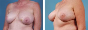 DIEP Flap Breast Reconstruction Chicago