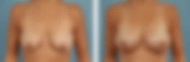 Breast reconstruction before and after