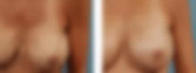 Breast Revision in Chicago