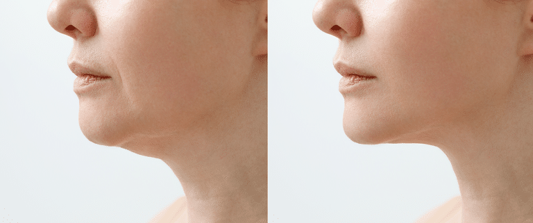 Neck Lift Procedure Chicago