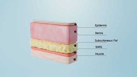 Male deep plane facelift Chicago 