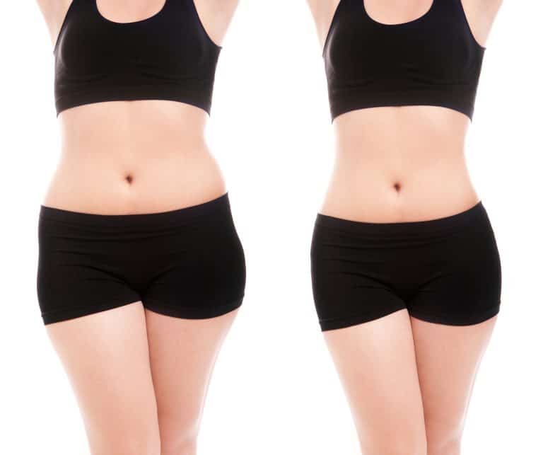 Liposuction