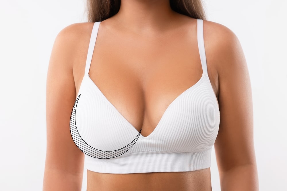 Revision Breast Reconstruction in Chicago, IL