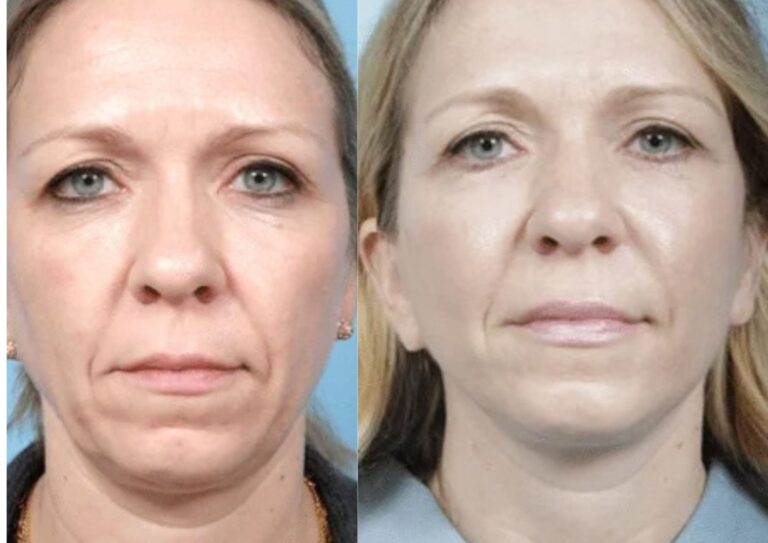 before and after facelift